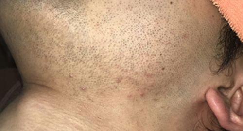 メンズクリア ヒゲ脱毛 の評判 口コミを調査 気になる料金 効果 サービスを解説します セレクト Gooランキング