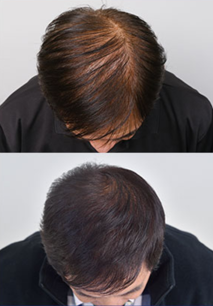 ニューモのテレビcmはうざい 発売から2年で売上no 1 の理由とは セレクト Gooランキング